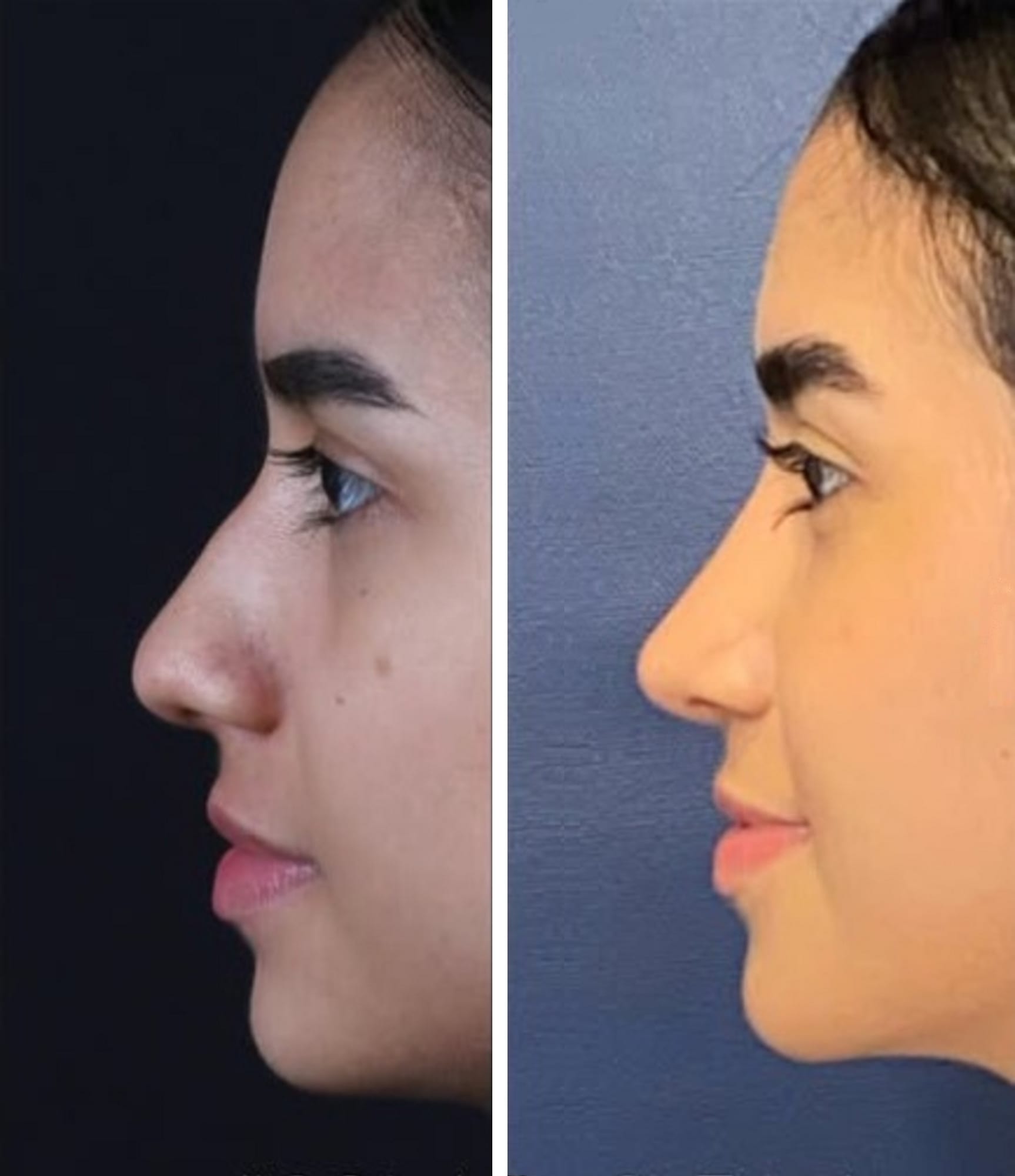 Rinoplastia caso 1 — antes y después